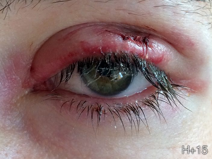 Chalazion.Me Opération chirurgicale pour mon chalazion